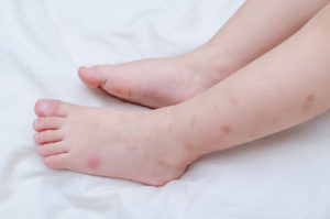 Bed bugs bites sore on baby legs